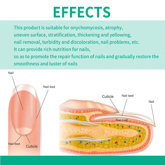 Nail fungus solution