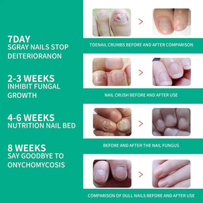 Nail fungus solution